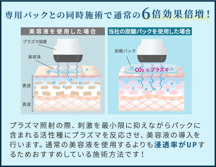 シミプラズマネオ×炭酸パック
